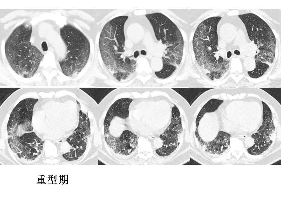 【PPT】新冠肺炎的CT诊断及鉴别诊断