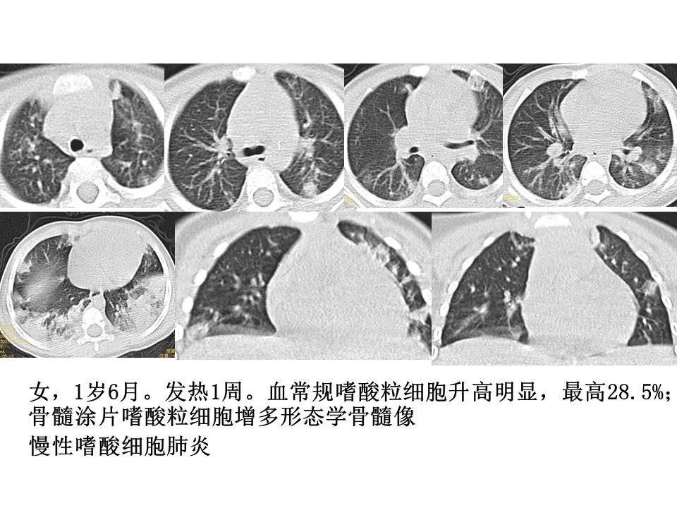 【PPT】新冠肺炎的CT诊断及鉴别诊断