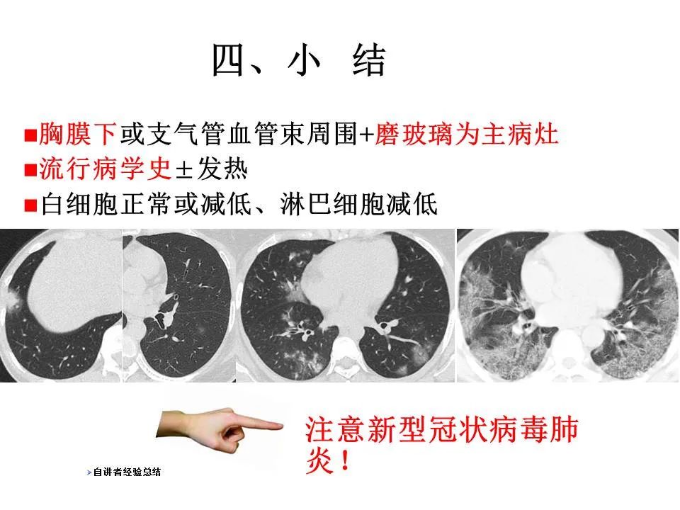 【PPT】新冠肺炎的CT诊断及鉴别诊断