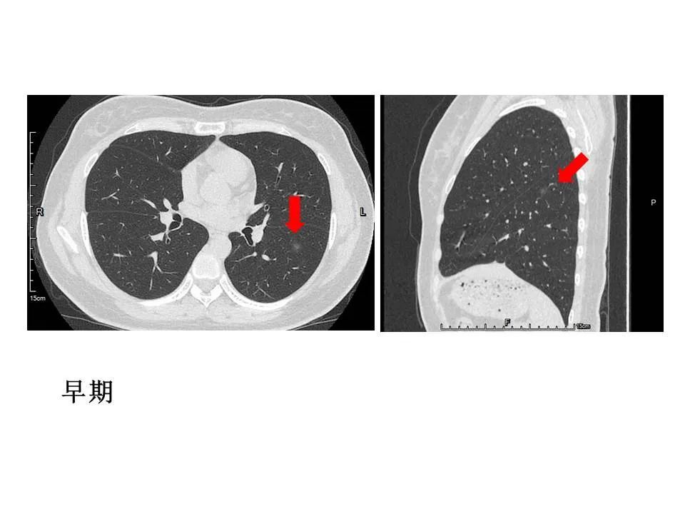 【PPT】新冠肺炎的CT诊断及鉴别诊断