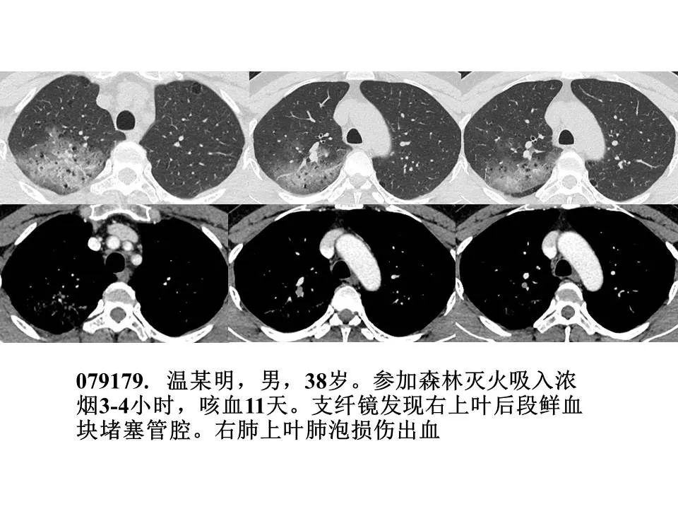 【PPT】新冠肺炎的CT诊断及鉴别诊断