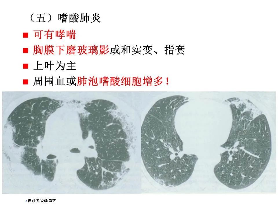 【PPT】新冠肺炎的CT诊断及鉴别诊断