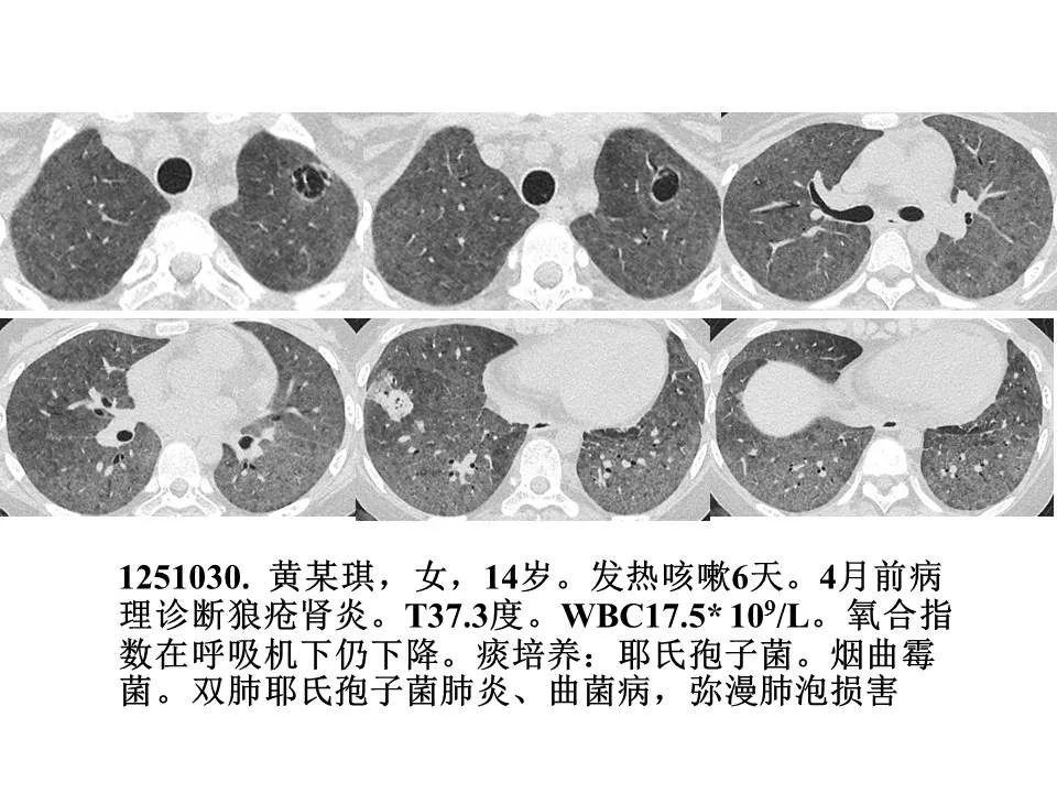 【PPT】新冠肺炎的CT诊断及鉴别诊断