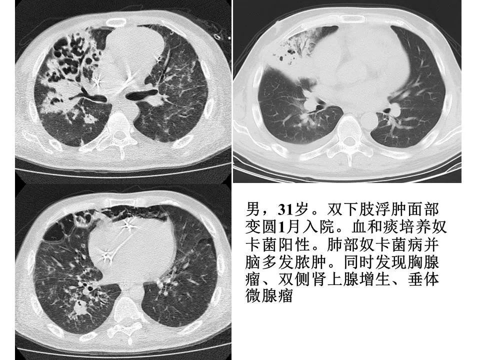 【PPT】新冠肺炎的CT诊断及鉴别诊断