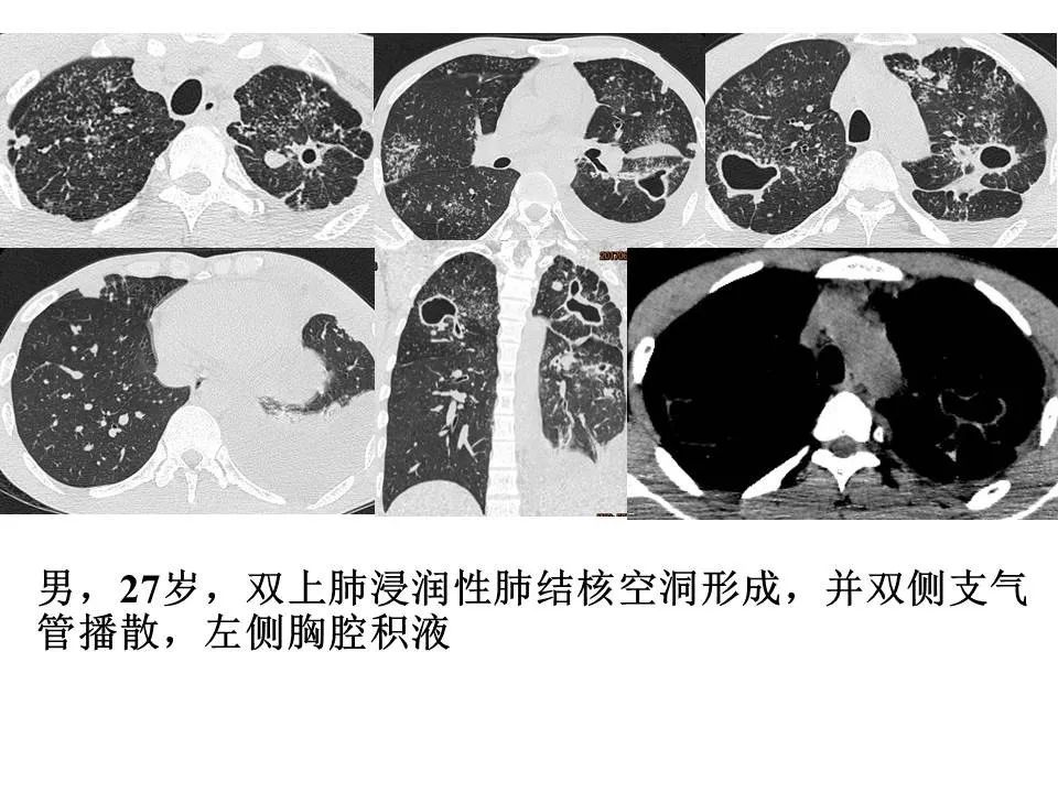 【PPT】新冠肺炎的CT诊断及鉴别诊断