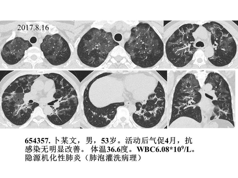【PPT】新冠肺炎的CT诊断及鉴别诊断