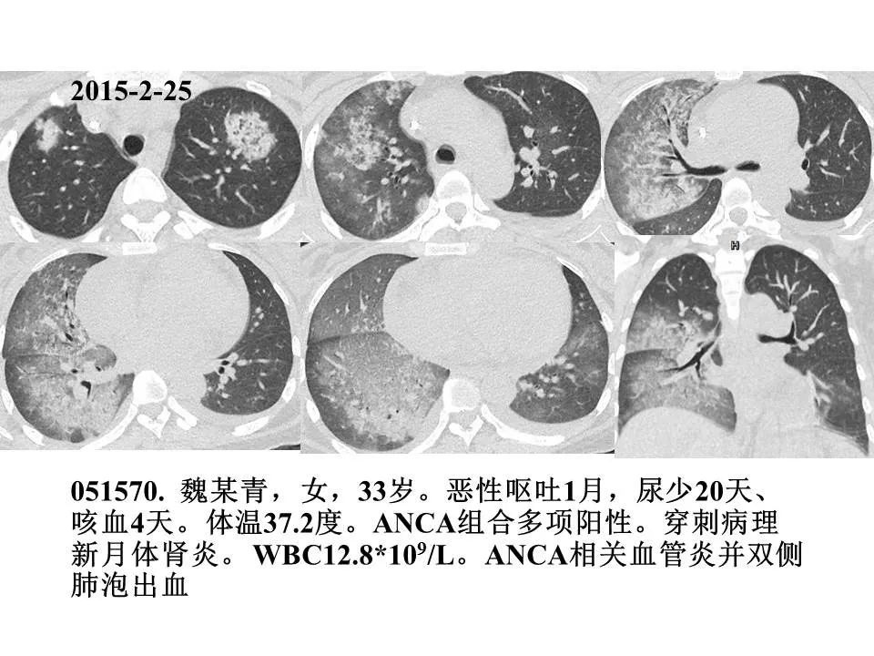【PPT】新冠肺炎的CT诊断及鉴别诊断