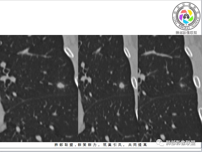 【病例】隐球菌1例CT影像讨论