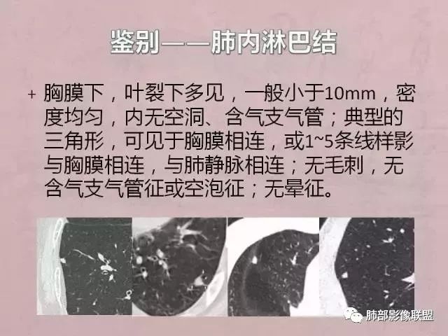 【病例】隐球菌1例CT影像讨论