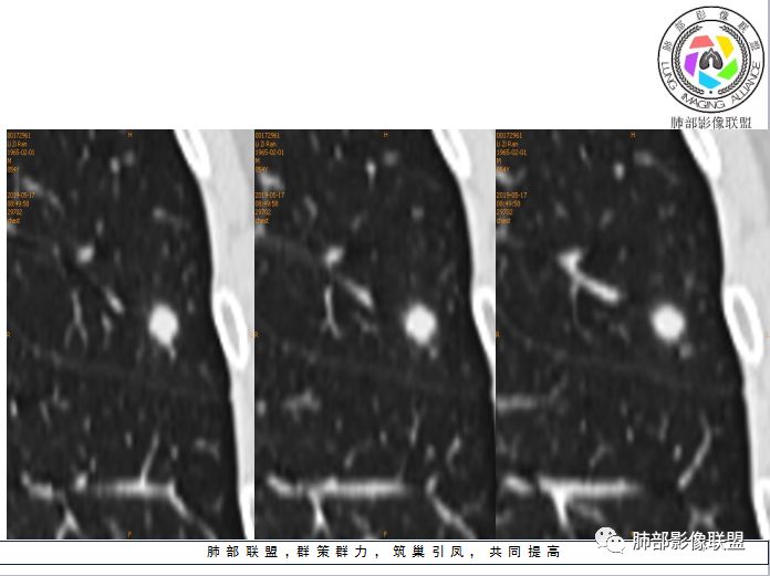 【病例】隐球菌1例CT影像讨论
