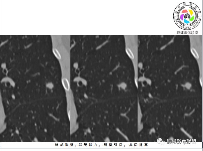 【病例】隐球菌1例CT影像讨论