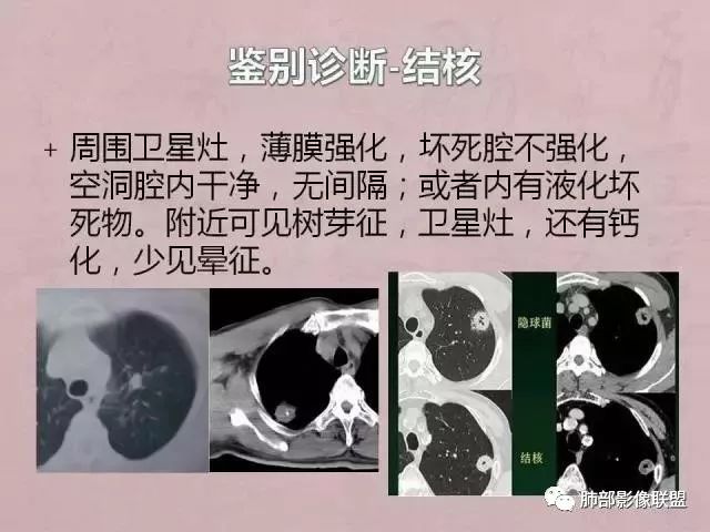【病例】隐球菌1例CT影像讨论