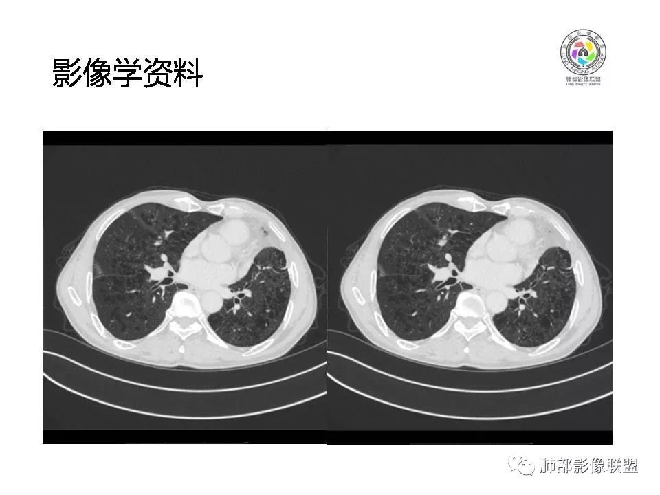 【病例】肺大细胞神经内分泌癌1例CT影像讨论