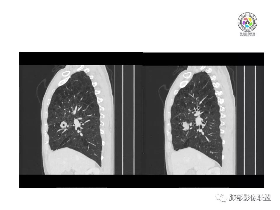 【病例】肺大细胞神经内分泌癌1例CT影像讨论
