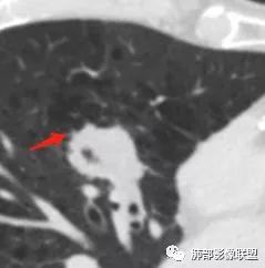 【病例】肺大细胞神经内分泌癌1例CT影像讨论
