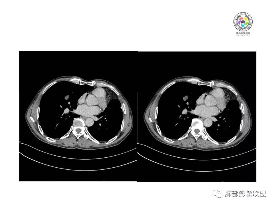 【病例】肺大细胞神经内分泌癌1例CT影像讨论