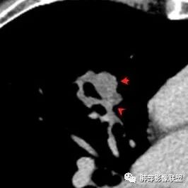 【病例】肺大细胞神经内分泌癌1例CT影像讨论