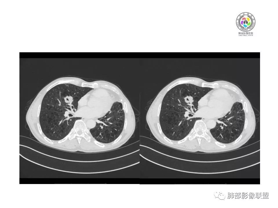 【病例】肺大细胞神经内分泌癌1例CT影像讨论