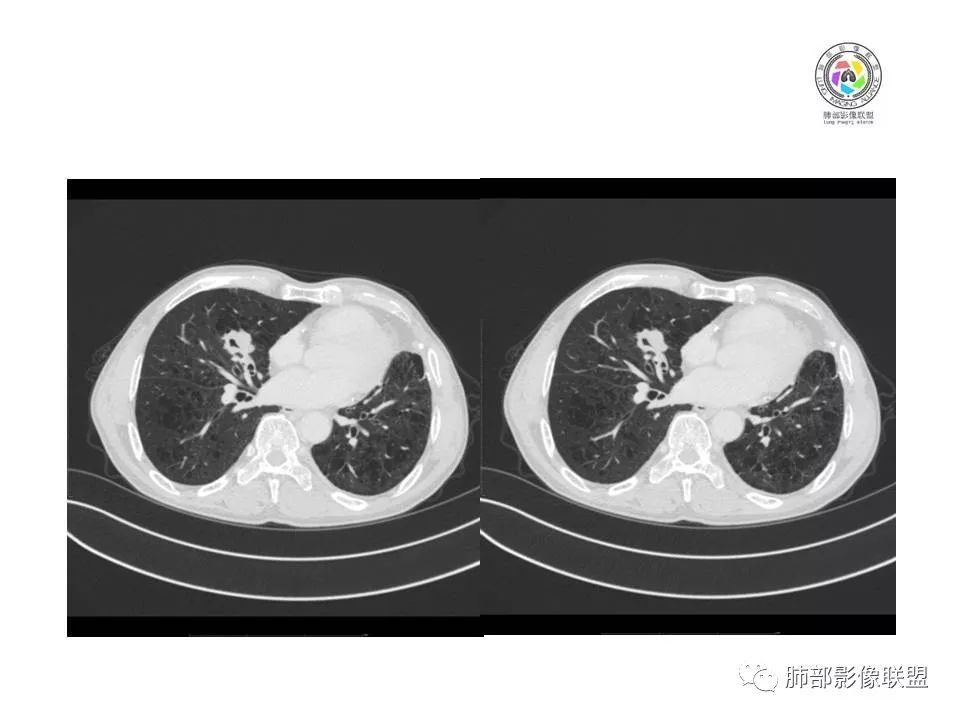 【病例】肺大细胞神经内分泌癌1例CT影像讨论