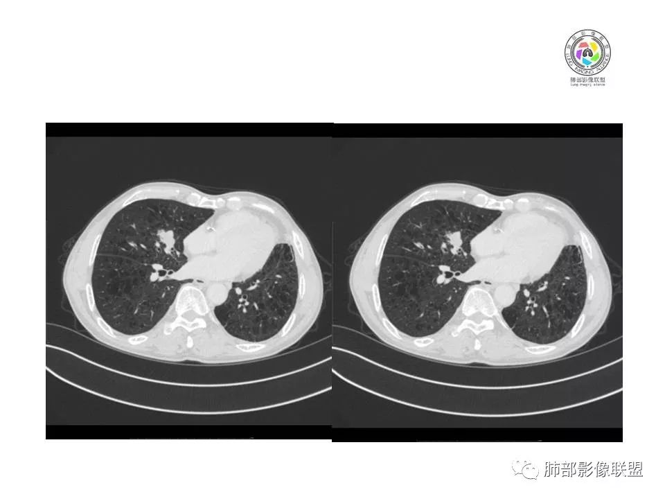 【病例】肺大细胞神经内分泌癌1例CT影像讨论
