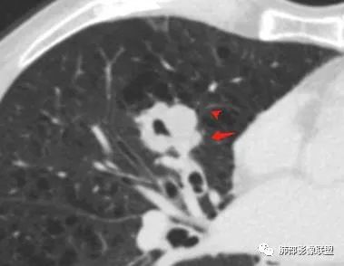 【病例】肺大细胞神经内分泌癌1例CT影像讨论