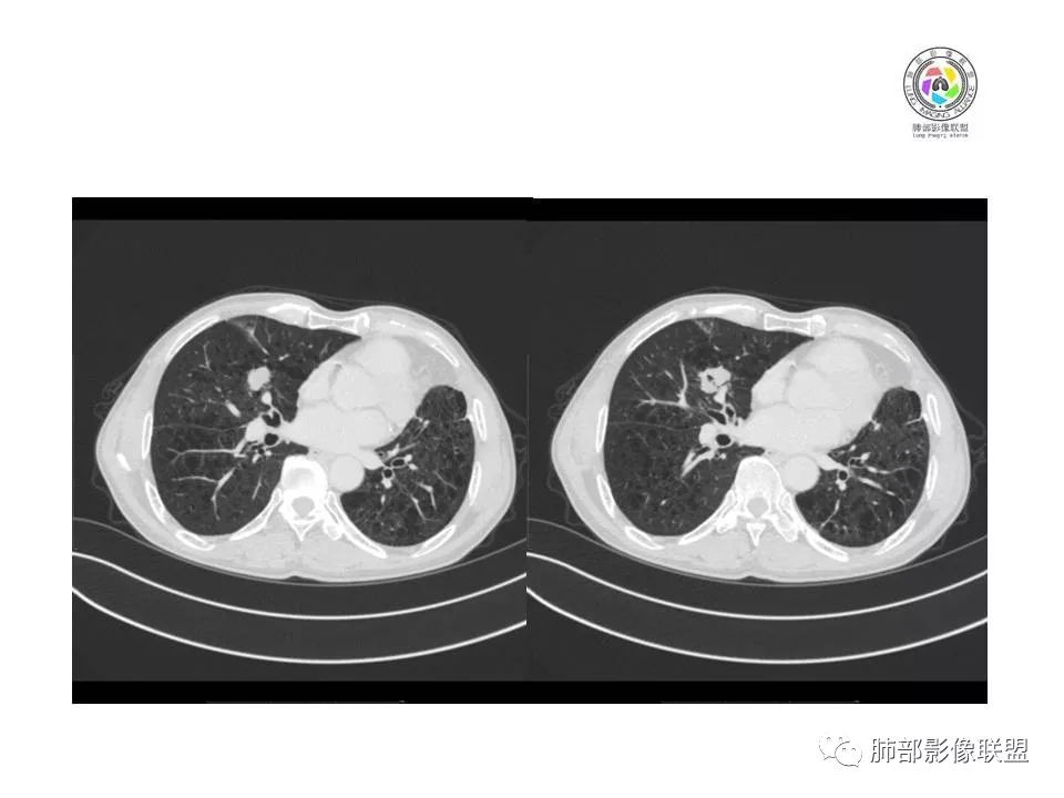 【病例】肺大细胞神经内分泌癌1例CT影像讨论