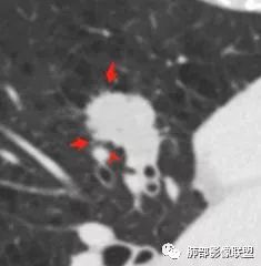 【病例】肺大细胞神经内分泌癌1例CT影像讨论