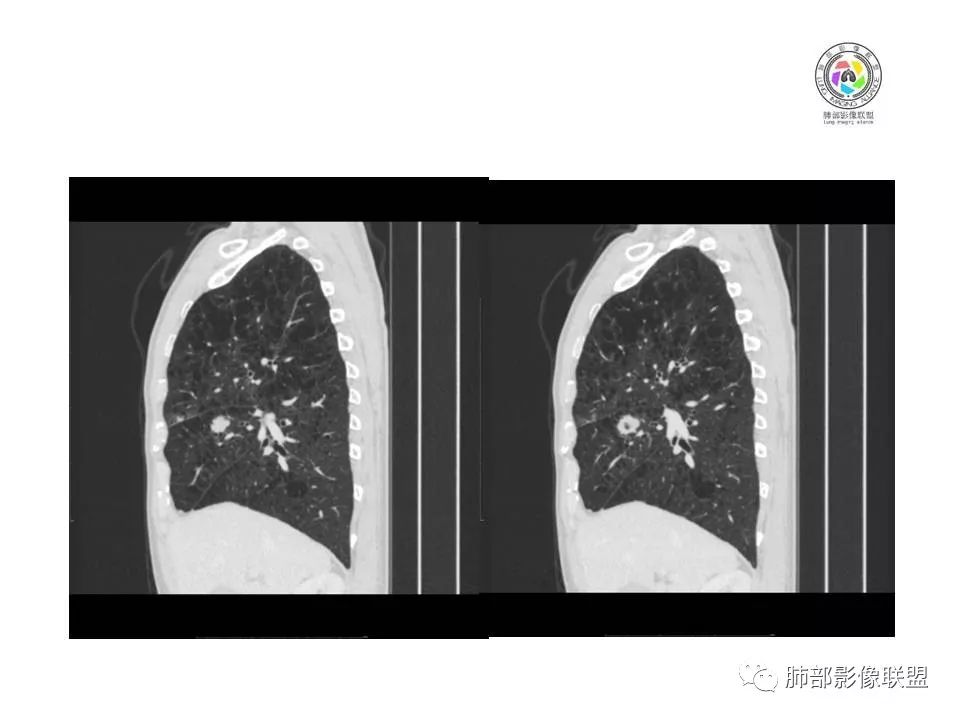 【病例】肺大细胞神经内分泌癌1例CT影像讨论