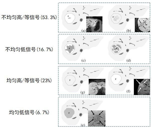 肝脏局灶性结节增生FNH影像特点