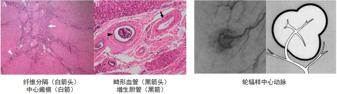 肝脏局灶性结节增生FNH影像特点