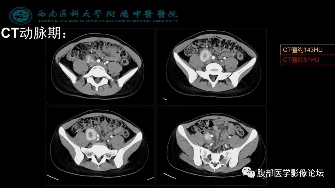 【病例】髂窝淋巴结炎性假瘤1例CT及MR影像诊断