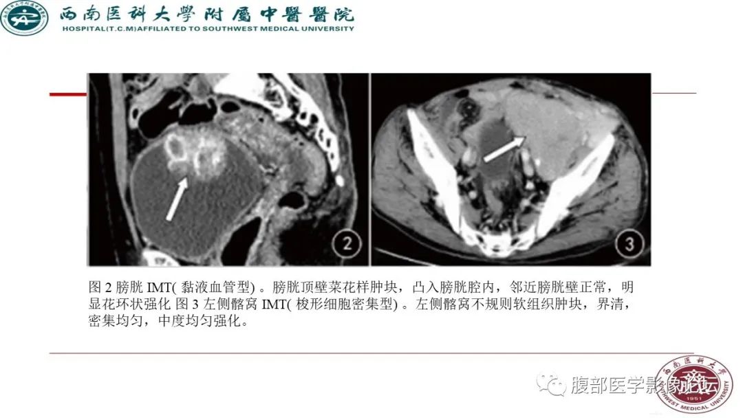 【病例】髂窝淋巴结炎性假瘤1例CT及MR影像诊断