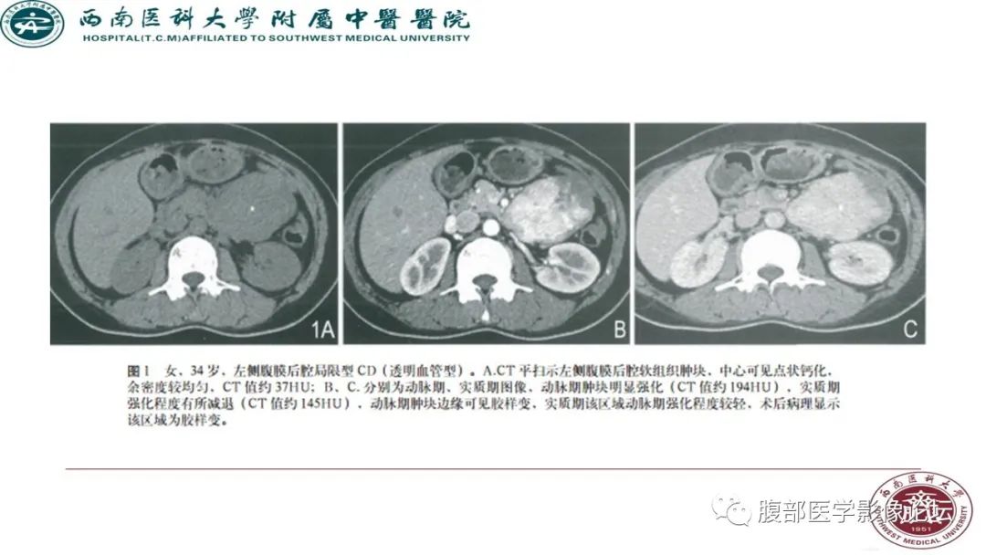 【病例】髂窝淋巴结炎性假瘤1例CT及MR影像诊断