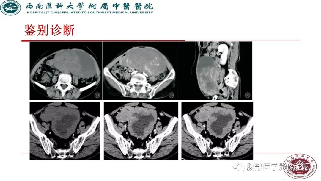 【病例】髂窝淋巴结炎性假瘤1例CT及MR影像诊断