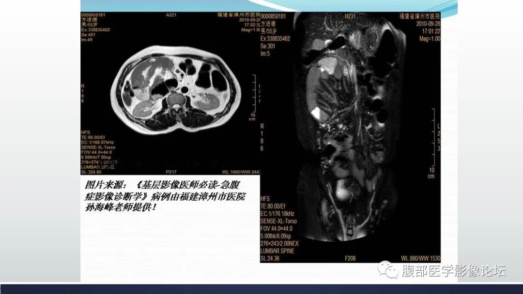 【病例】腹内疝1例CT影像诊断