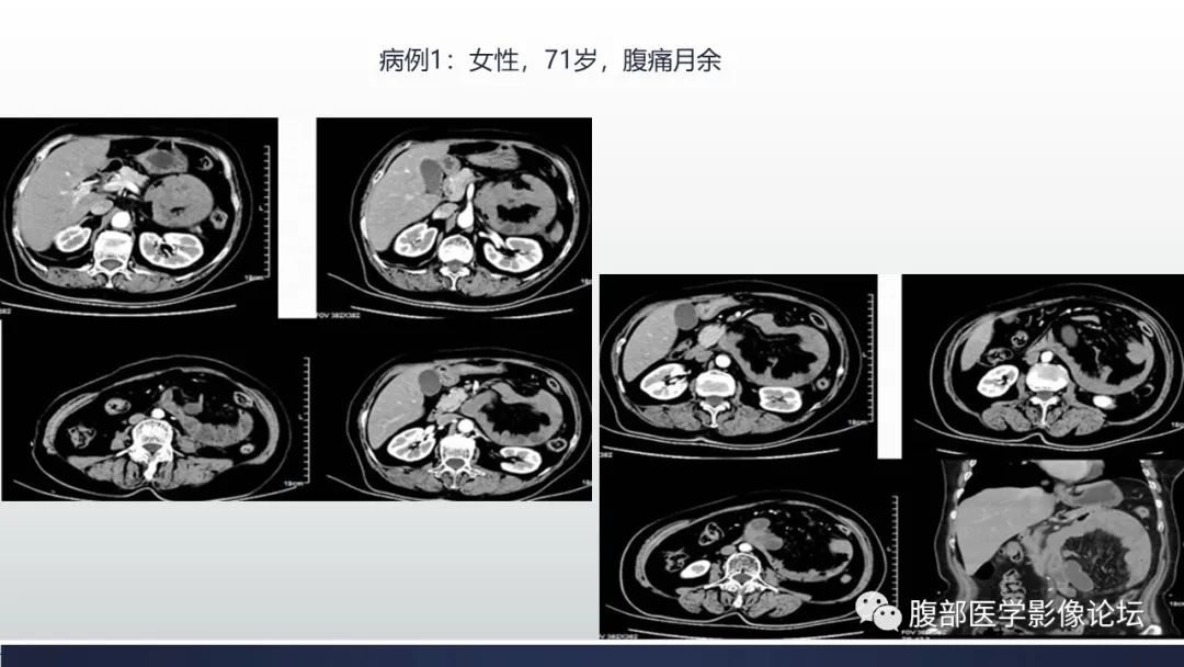 【病例】腹内疝1例CT影像诊断