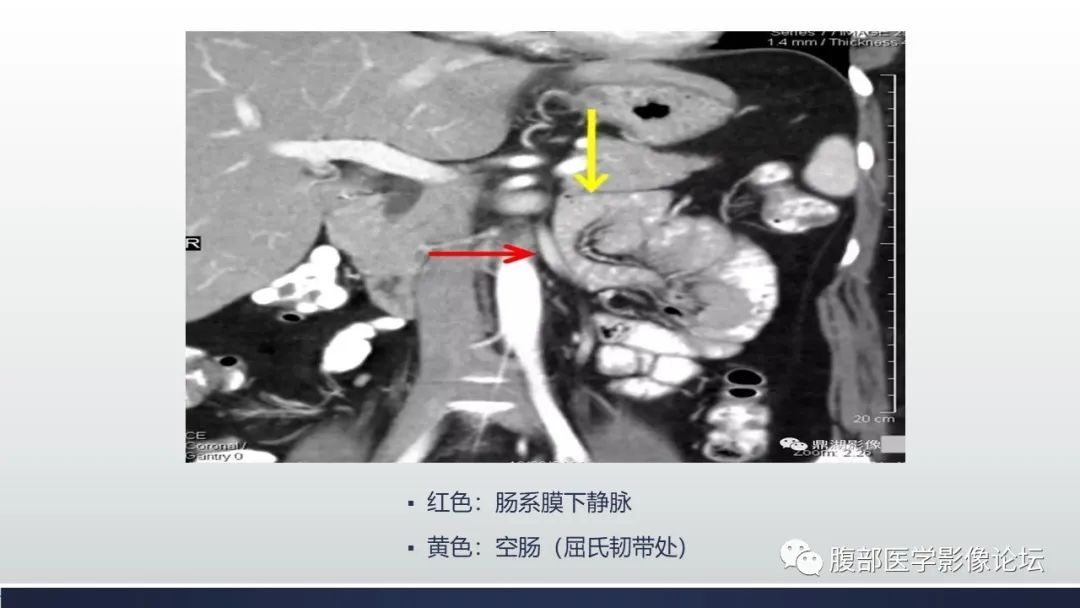 【病例】腹内疝1例CT影像诊断