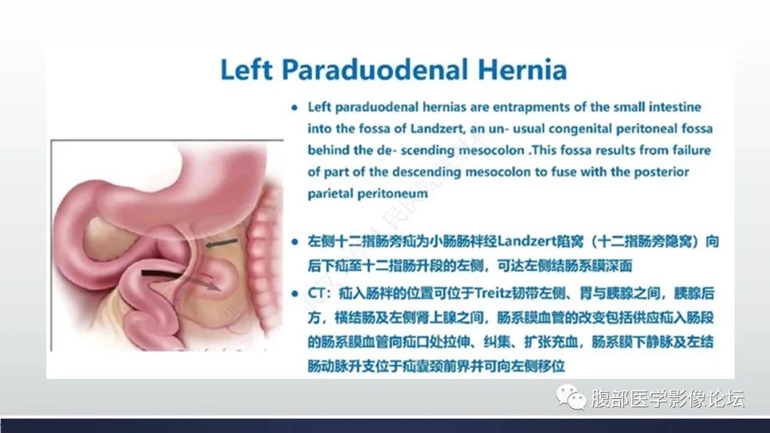【病例】腹内疝1例CT影像诊断