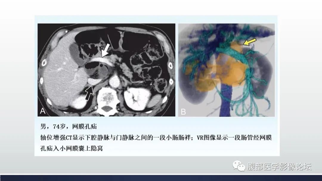 【病例】腹内疝1例CT影像诊断