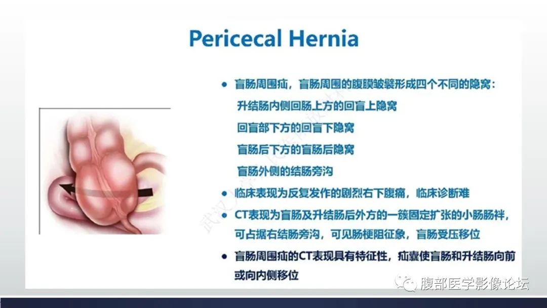 【病例】腹内疝1例CT影像诊断