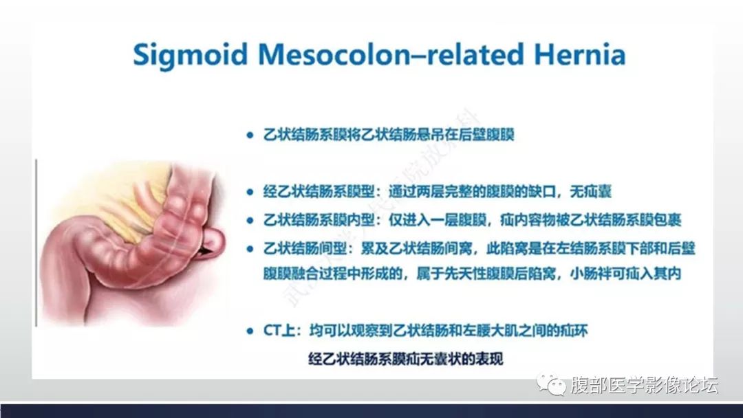【病例】腹内疝1例CT影像诊断