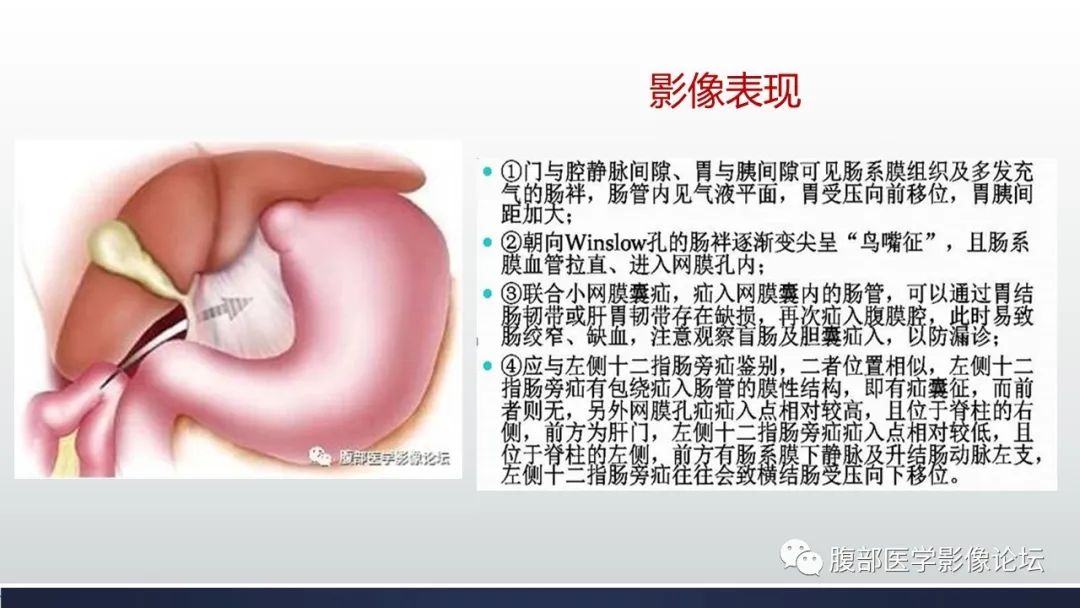 【病例】腹内疝1例CT影像诊断