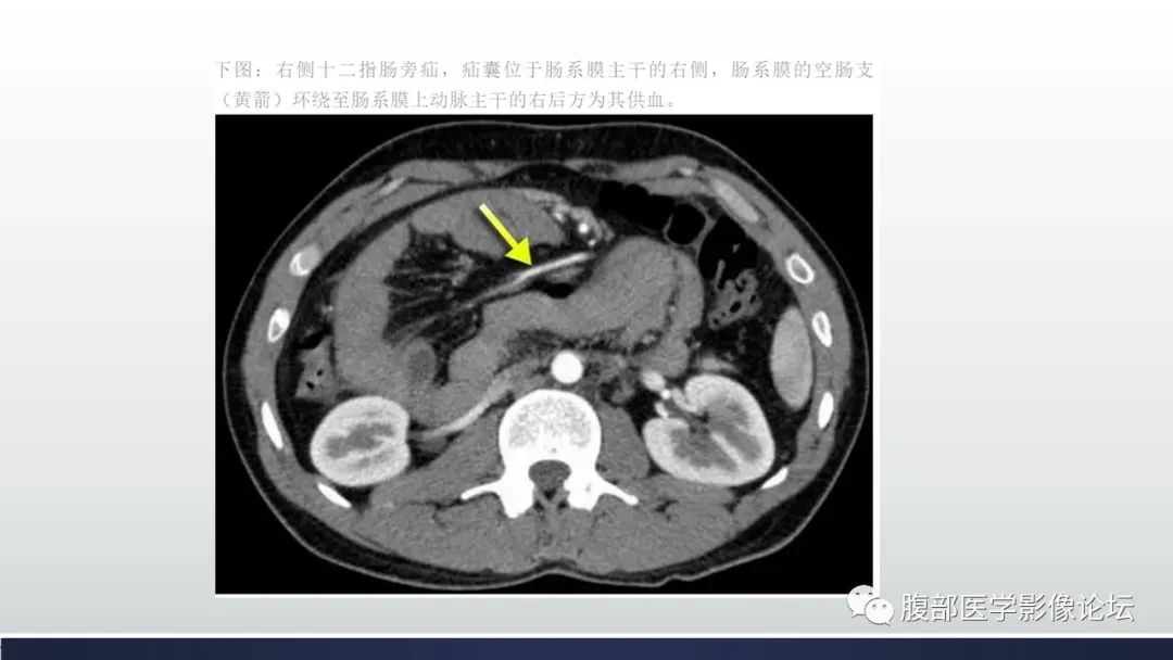 【病例】腹内疝1例CT影像诊断