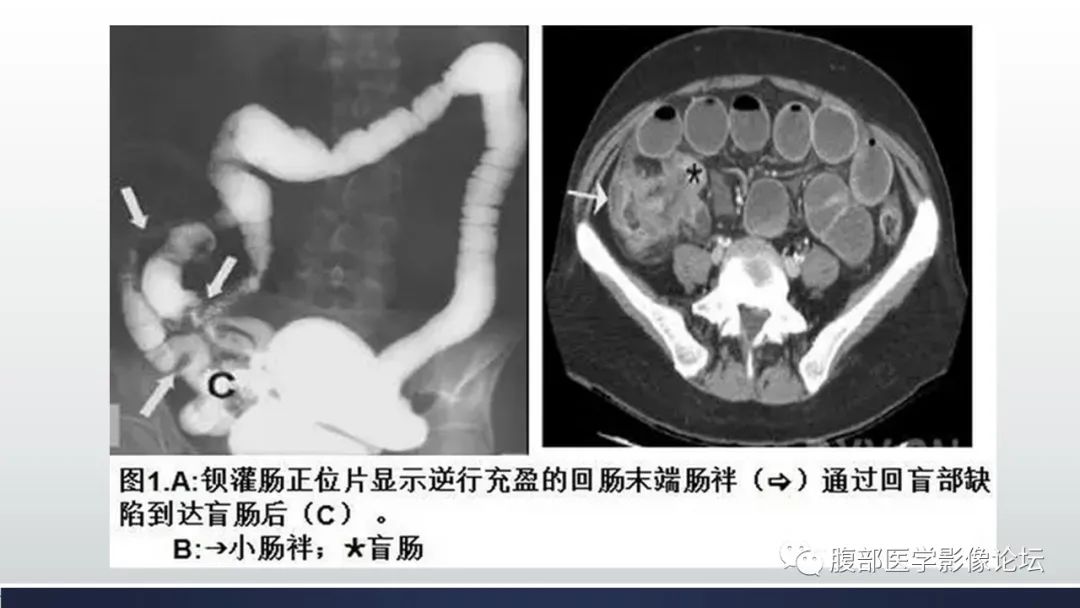 【病例】腹内疝1例CT影像诊断