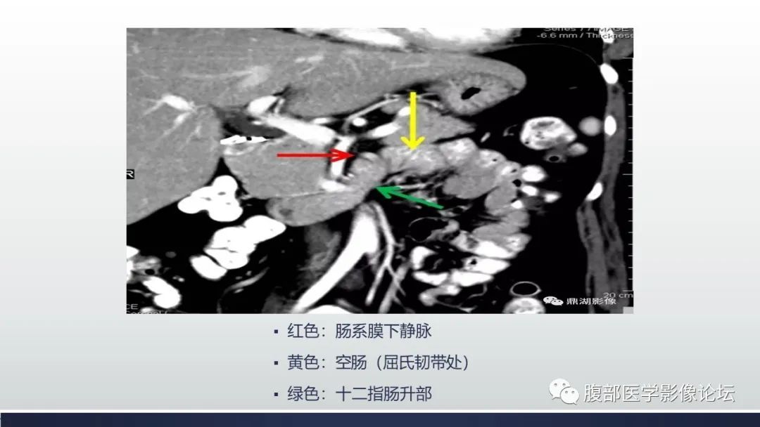 【病例】腹内疝1例CT影像诊断