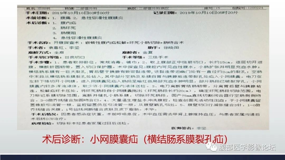 【病例】腹内疝1例CT影像诊断