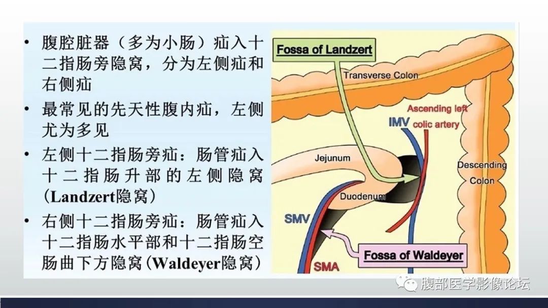 【病例】腹内疝1例CT影像诊断