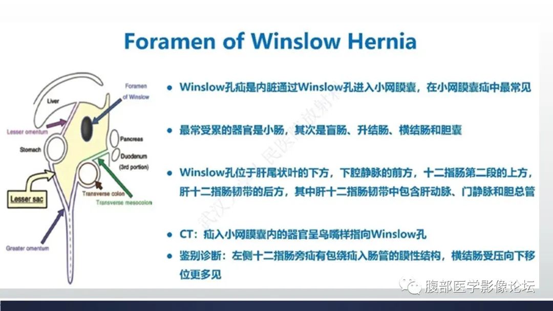 【病例】腹内疝1例CT影像诊断