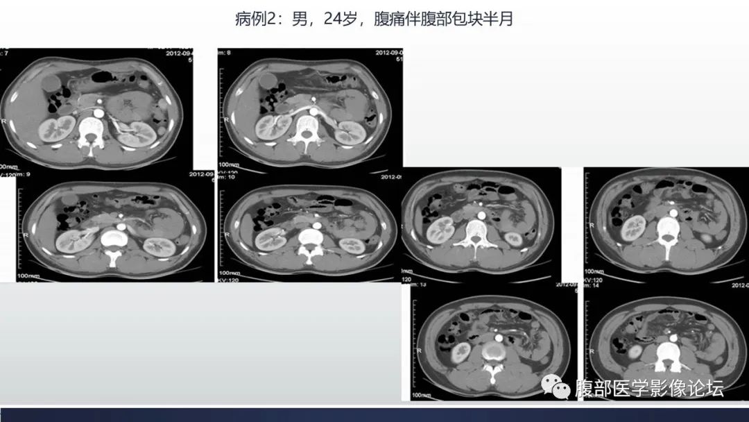 【病例】腹内疝1例CT影像诊断