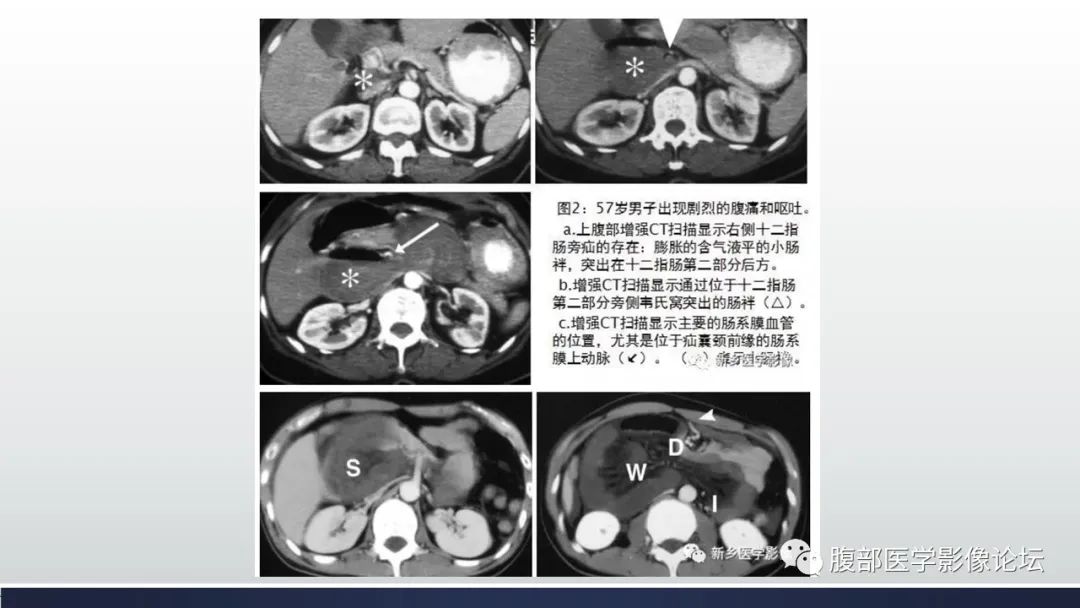 【病例】腹内疝1例CT影像诊断